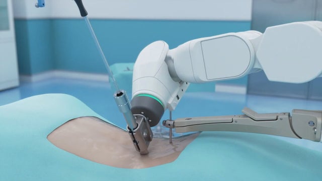 100TH-ROBOT-SPINE-SURGERY-6PKG.transfer_frame_1759.jpeg 