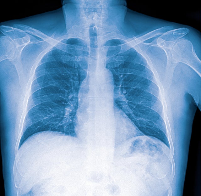 X-ray image of lung with pneumonia