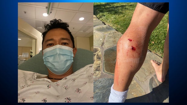 Moraga coyote attack victim Kenji Sytz 