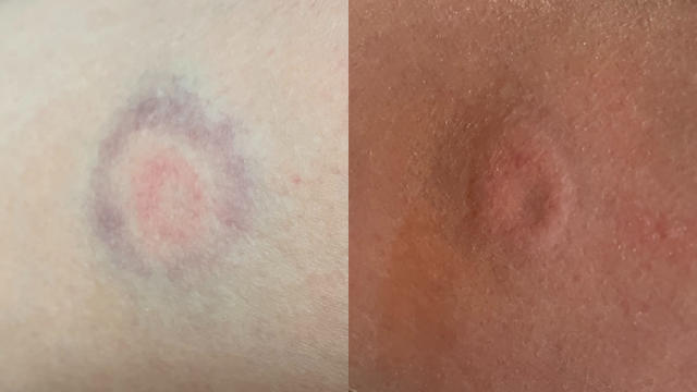 paintball bruises