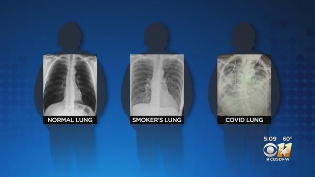 COVID-19 lung 