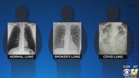 normal-smokers-covid-chest-x-rays.jpg 