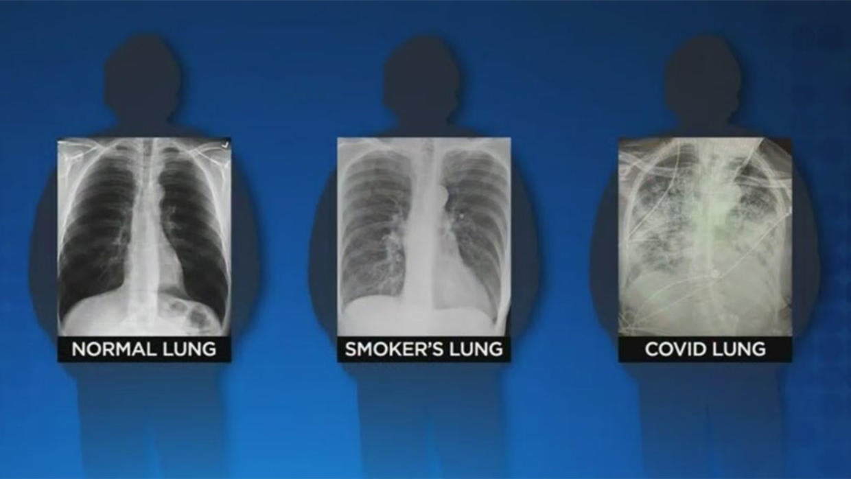 Doctors Say Even Asymptomatic COVID Cases Can Leave Patients With Lung ...