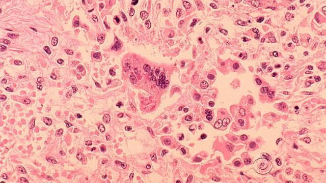 Siblings with measles could have exposed others at HCMC, state health department says