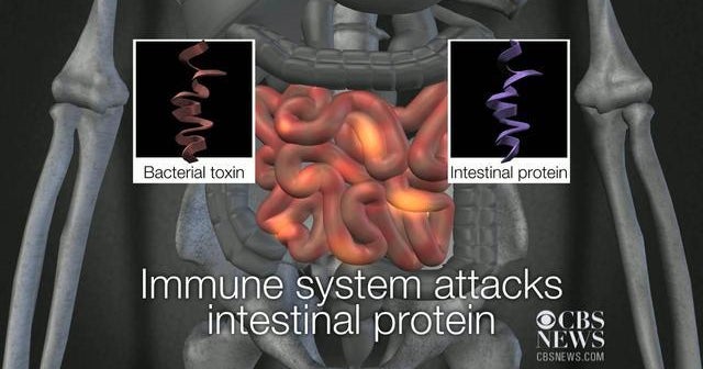 New blood test for IBS - CBS News