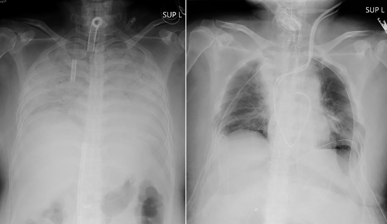 Virus Outbreak Japan Lung Transplant 