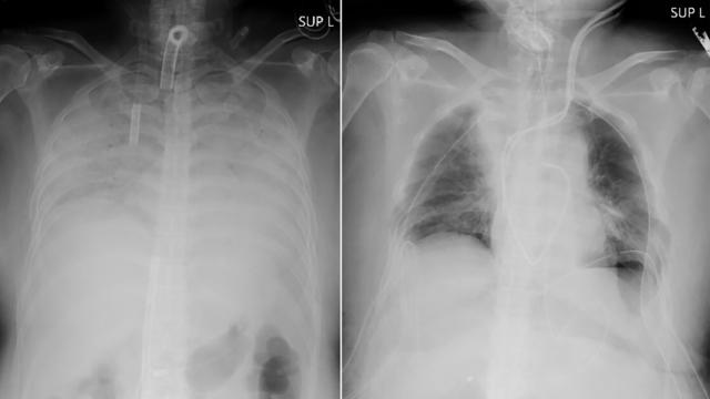 Virus Outbreak Japan Lung Transplant 