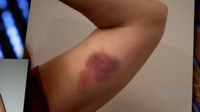 ipad-bruise-1063349-640x360.jpg 