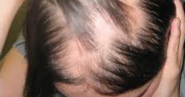 Drug shows promise for hair loss condition CBS News