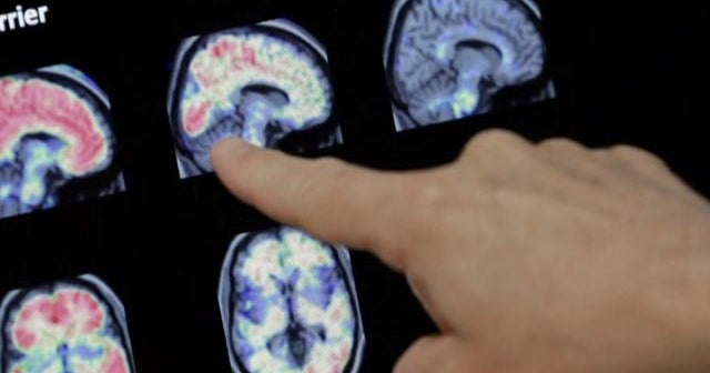 Examine: New Alzheimer’s diagnoses additional popular amid seniors who have experienced COVID