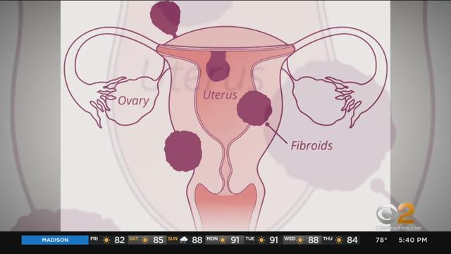 Uterine-Fibroids-moore.jpg 