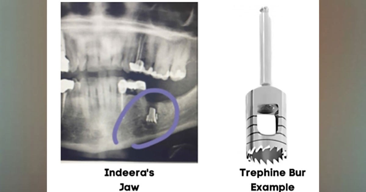 Texas Woman Sues Oral Surgeon After Metal Drill Bit Left Inside Her Jaw ...
