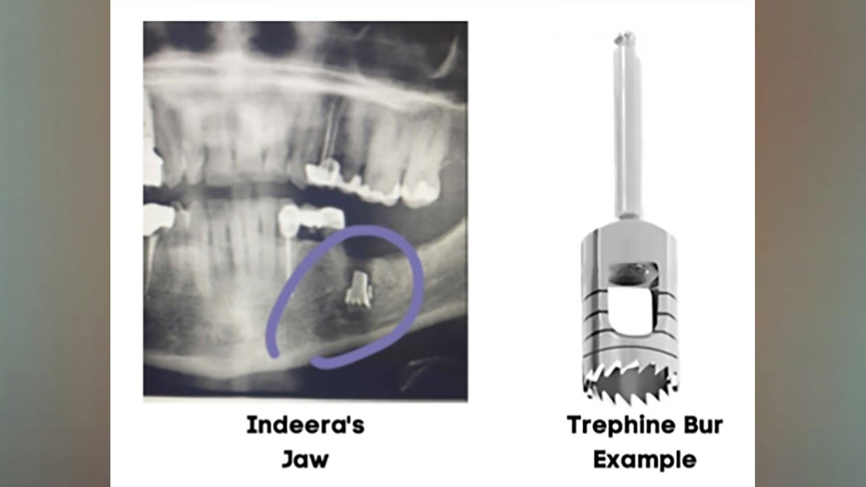 Texas Woman Sues Oral Surgeon After Metal Drill Bit Left Inside Her Jaw ...