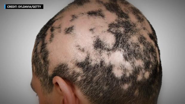First drug to treat hair loss disorder alopecia OK'd by FDA