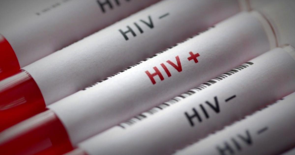 Long Term Survivor Living With Hiv Nearly 3 Decades After Diagnosis