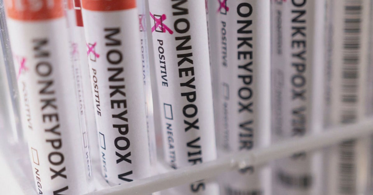 Dallas County reports two new monkeypox cases - CBS Texas