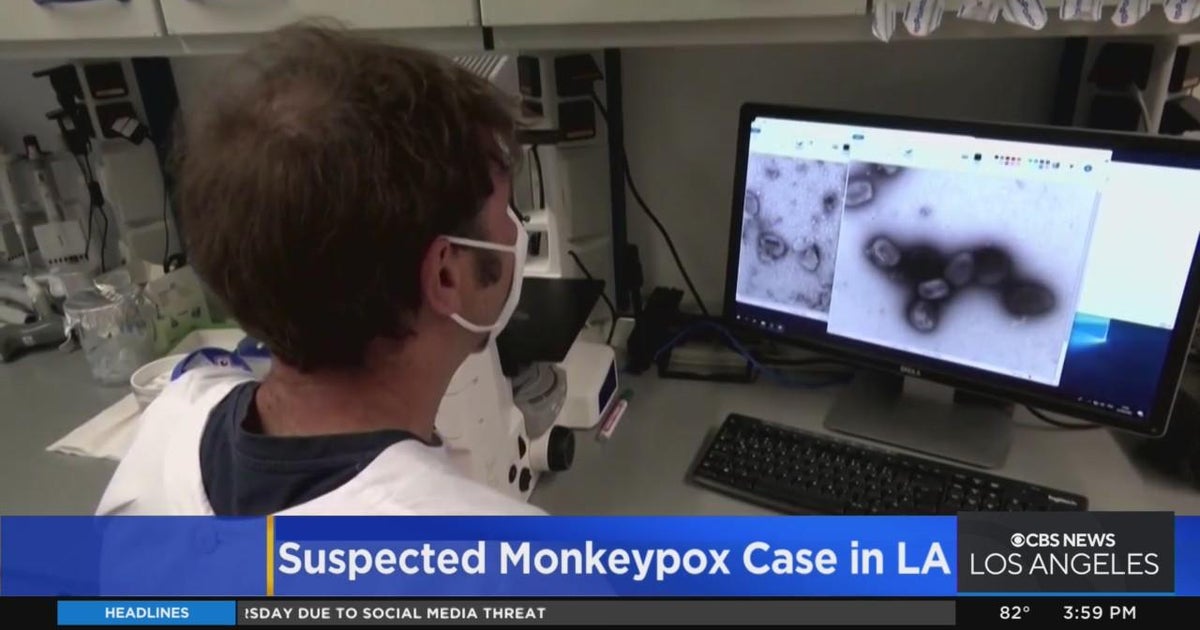 LA Public Health announced the first suspected case of monkeypox in the