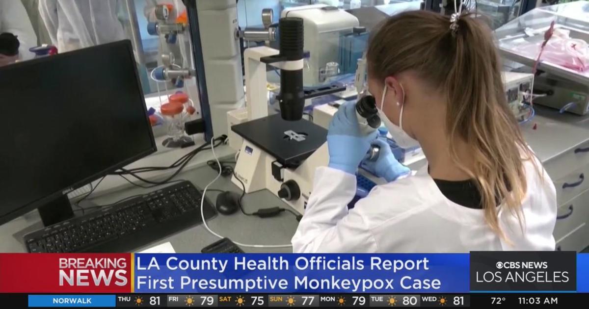 LA County reports first presumptive case of monkeypox CBS Los Angeles