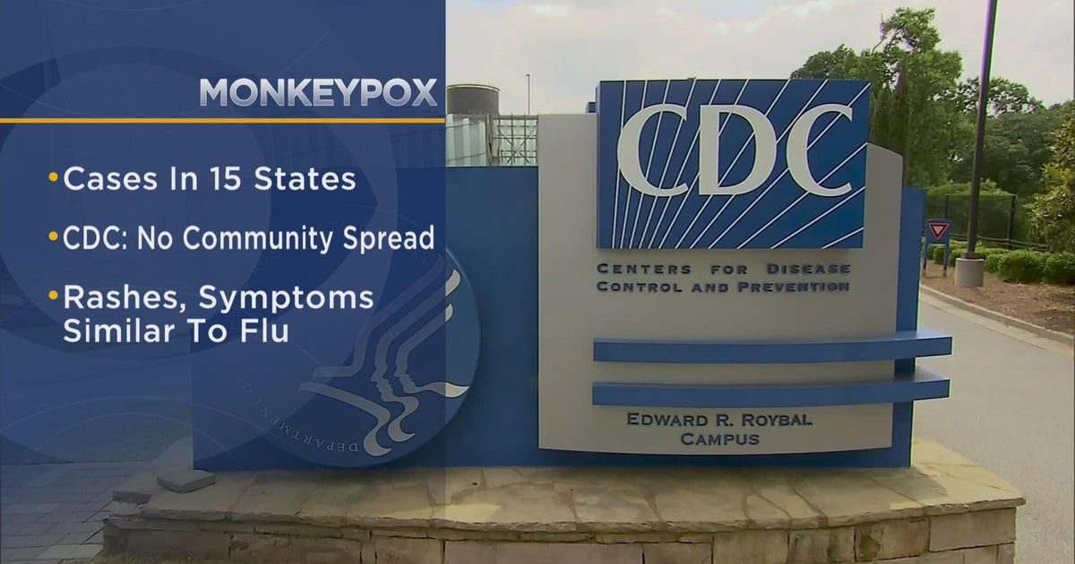 Illinois among 15 states with monkeypox cases CBS Chicago