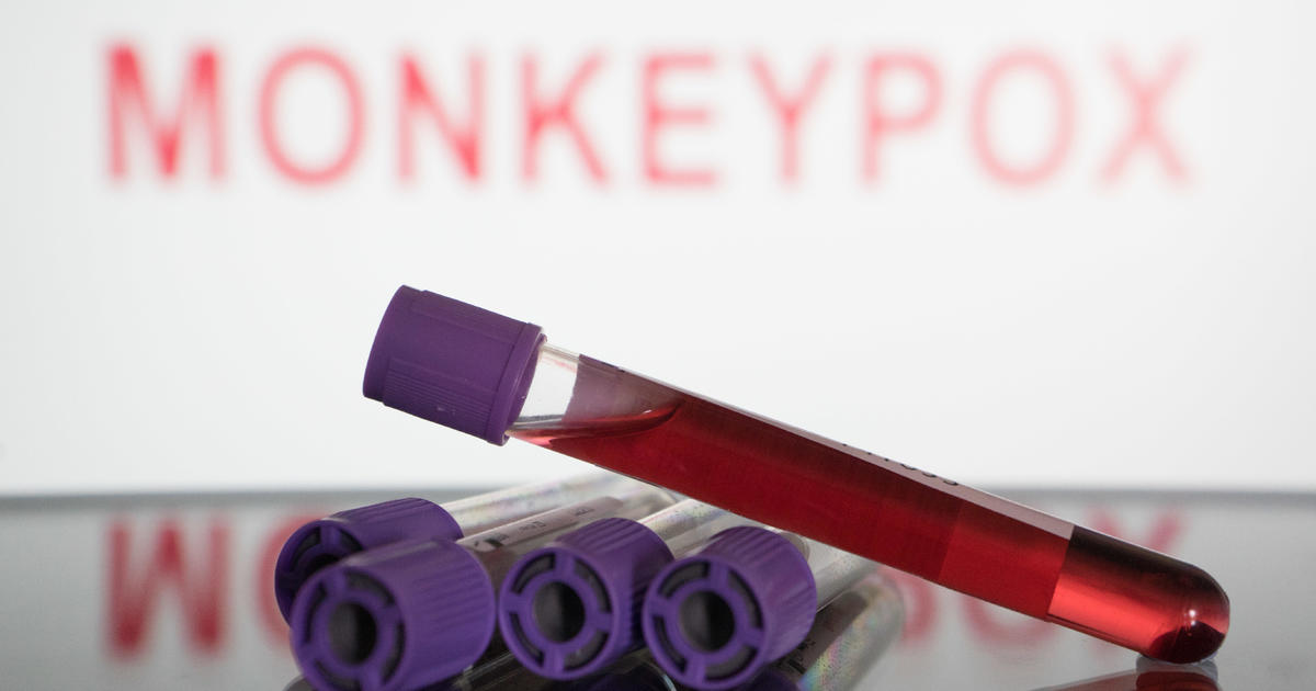 who-considers-declaring-monkeypox-a-global-health-emergency