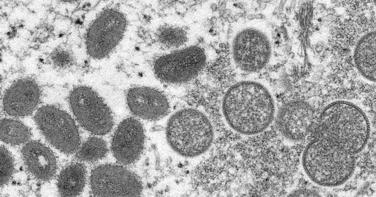 Six monkeypox cases confirmed in Twin Cities, MDH raises awareness