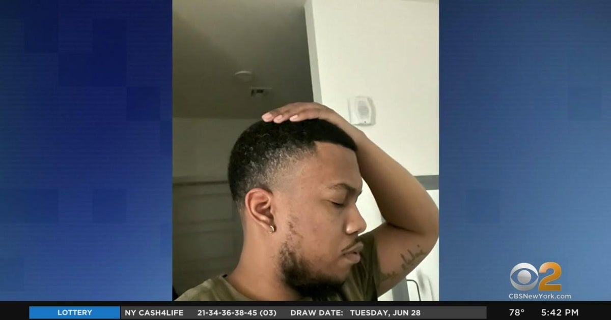 FDA approves first-of-its-kind treatment for severe alopecia - CBS New York