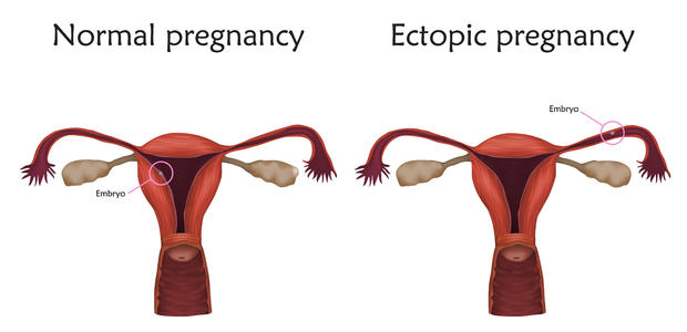 Ectopic pregnancy, illustration 