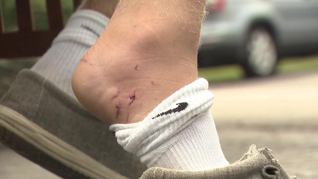 A young man partially pulls off his sock, showing several small bite marks and scars from a shark bite. 