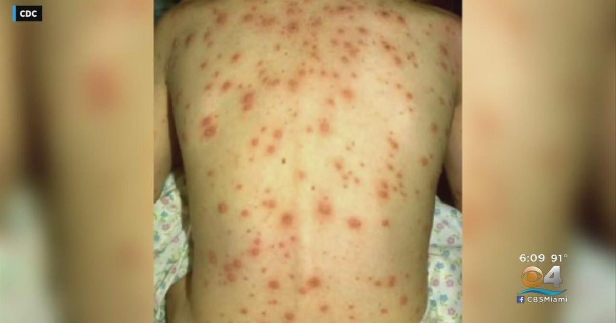 Pride Center in Wilton Manors offering free monkeypox vaccines