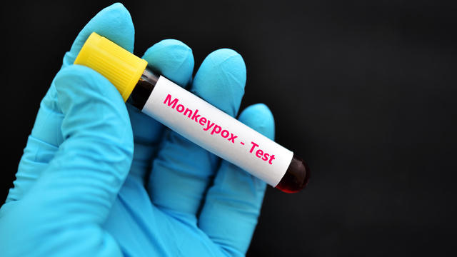 Blood for Monkeypox virus test 