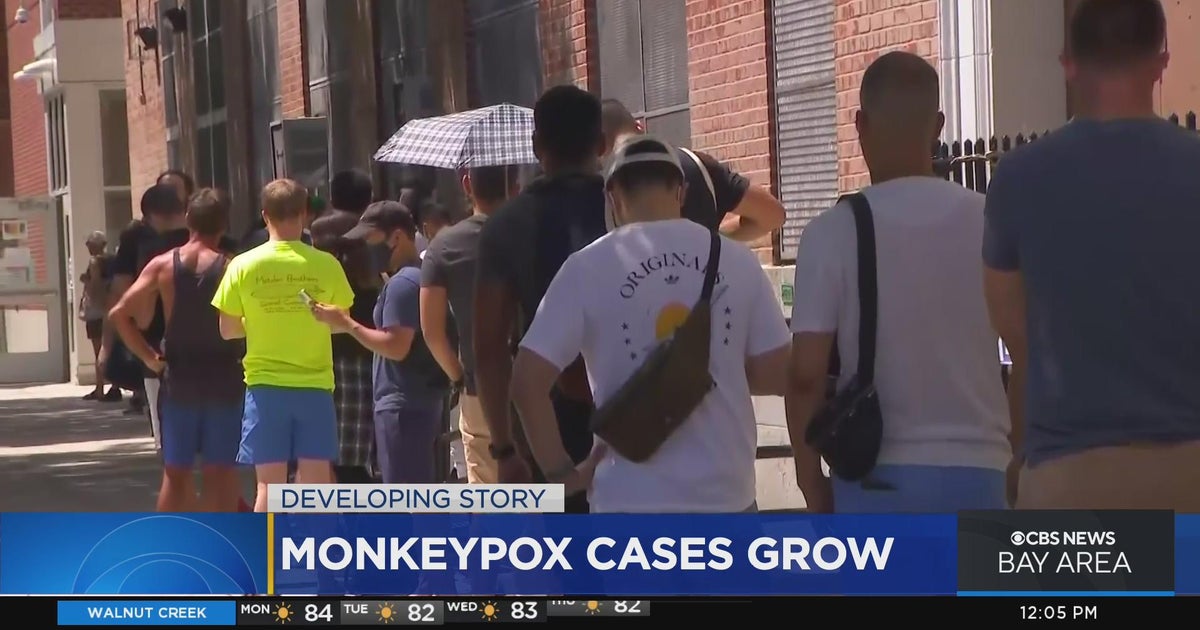 Cases of monkeypox grow across California and the U.S. - CBS San Francisco