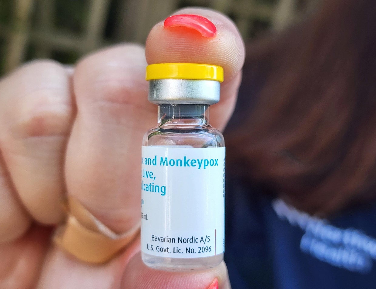 Monkeypox cases rising quickly in Colorado - CBS Colorado