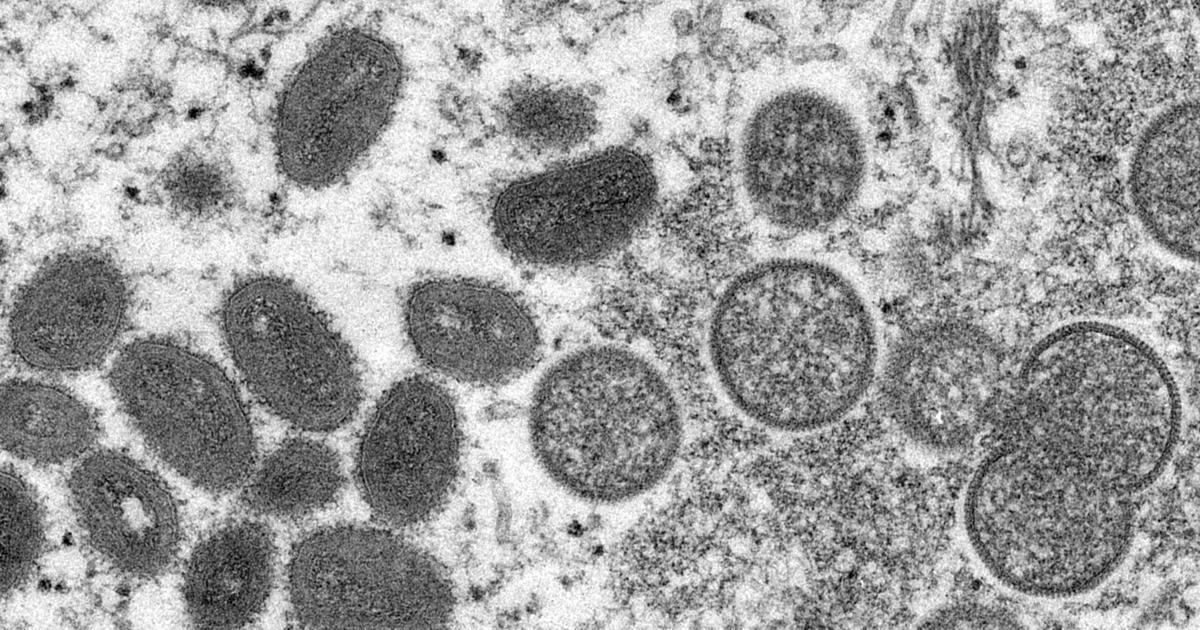 Maryland surpasses 100 monkeypox cases, vaccines remain scarce