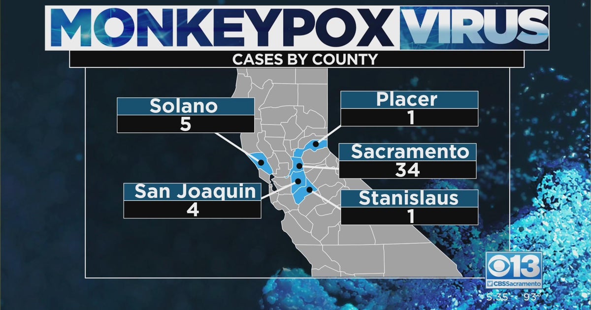 Placer County Reports First Known Case Of Monkeypox