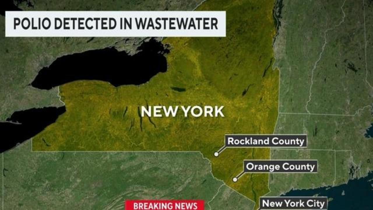 Polio detected in NYC waste water