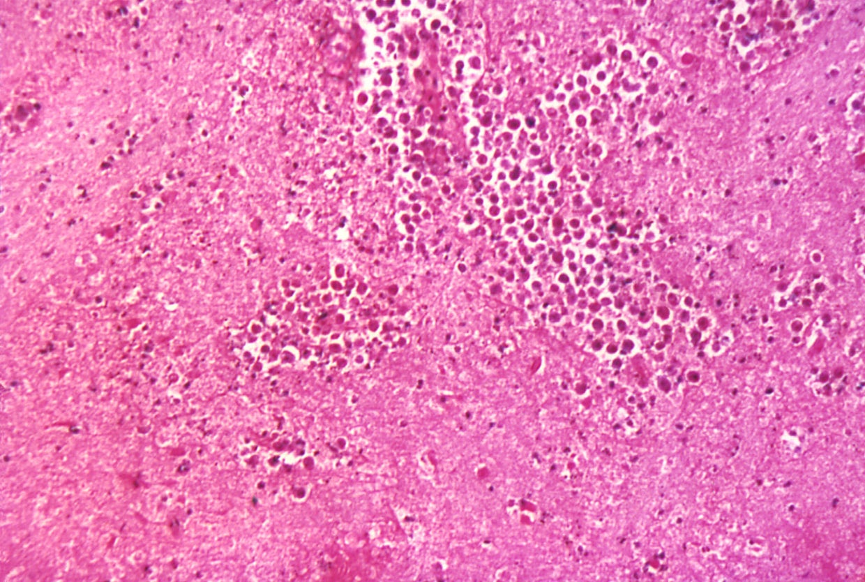 Braineating amoeba suspected in Nebraska child's death, officials say