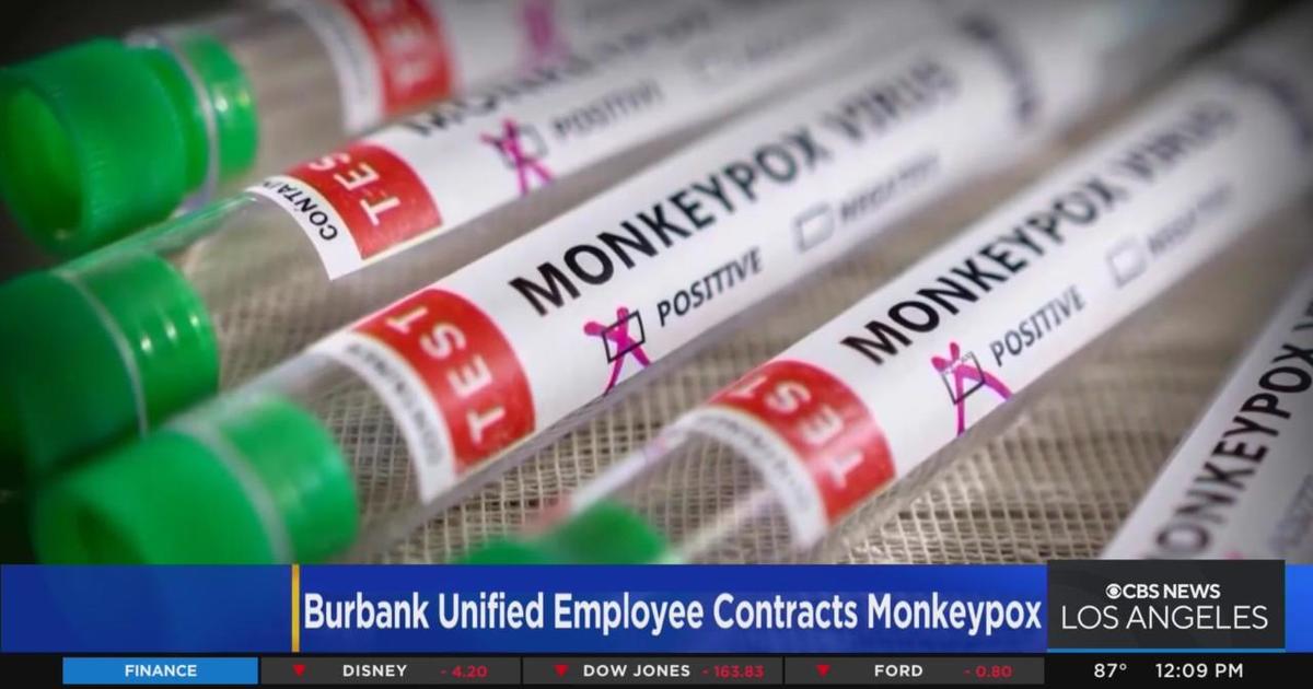 Burbank Unified employee tests positive for monkeypox CBS Los Angeles