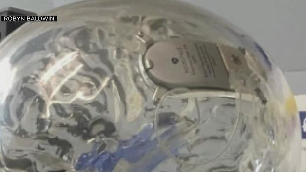 brain implant 