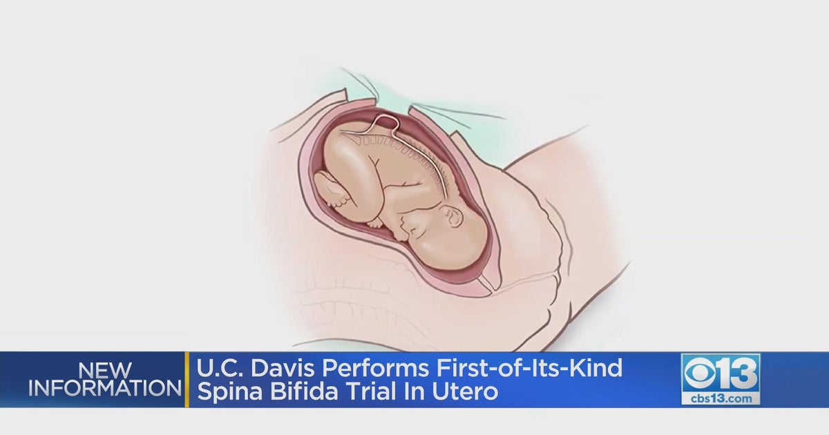 Can you cure Spina Bifida before birth?