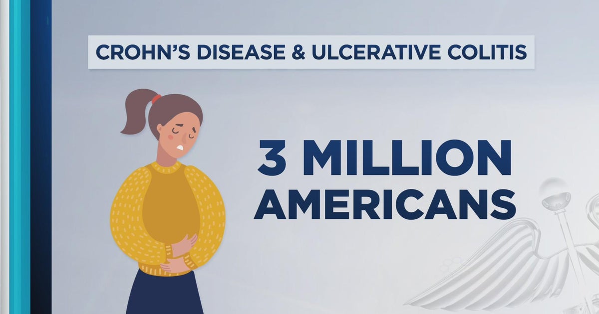 What it's really like living with Crohn's disease CBS Minnesota