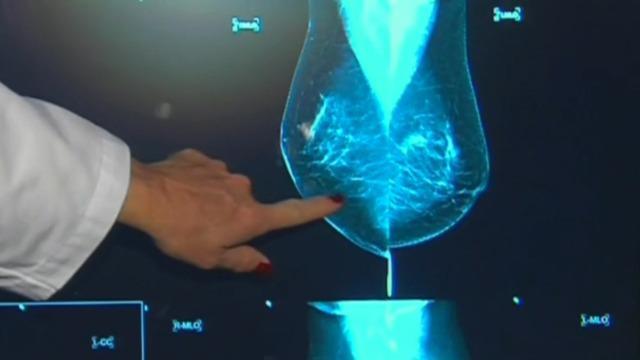 cbsn-fusion-breast-density-awareness-is-key-in-early-cancer-detection-thumbnail-1405402-640x360.jpg 