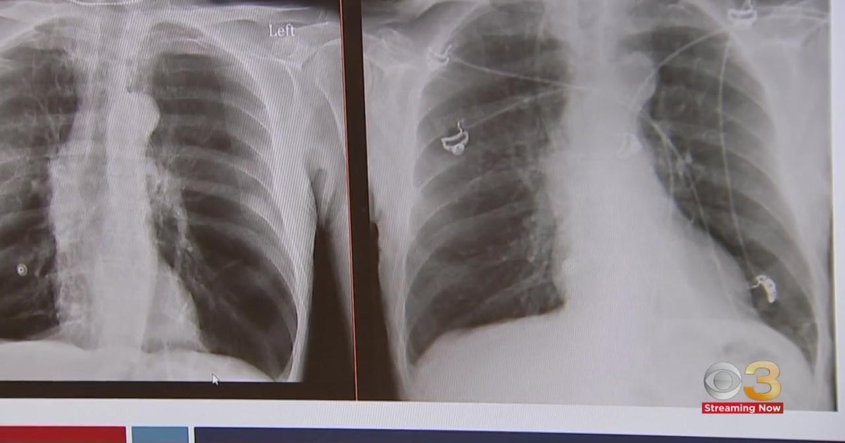 Chest X Ray Copd
