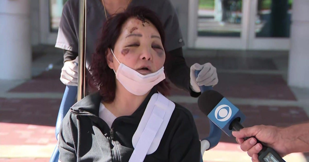 CBS4 Exceptional: Chicago tourist struck by strike-and-run driver leaves hospital