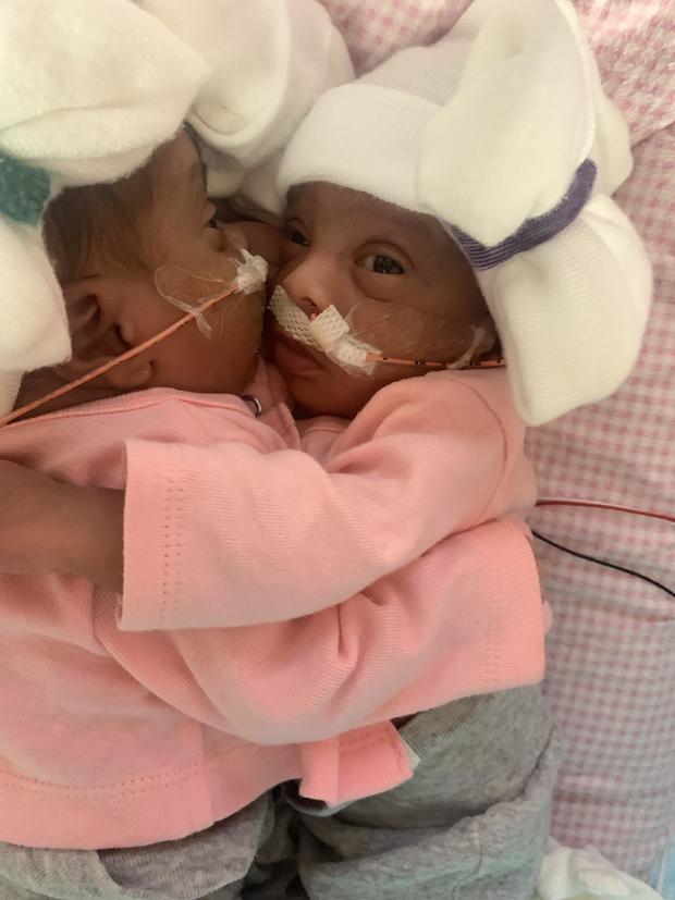 Conjoined twins separated in 11-hour “historic surgical procedure” at Texas hospital
