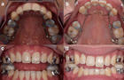 Before and after photos of a dental patient's teeth 