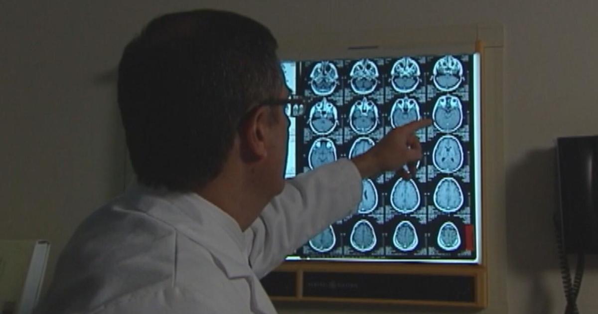 Artificial intelligence used at Mass General to identify patients at risk for Alzheimer’s disease