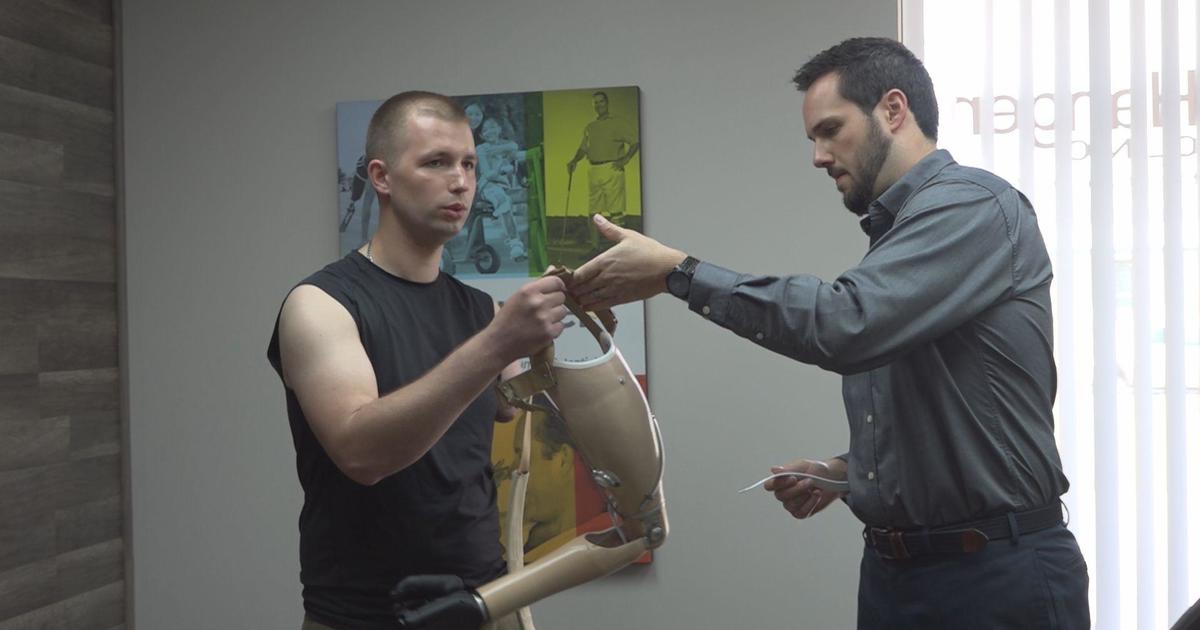 Український військовий, який втратив руку на полі бою, отримує протез руки в Ліфляндії