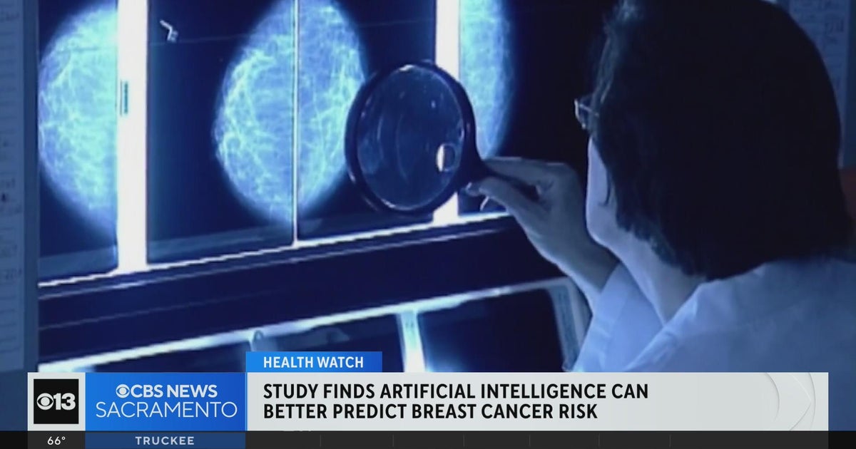 Study finds AI can better predict breast cancer risk