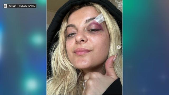 Bebe Rexha gives a thumbs up to the camera. She has a black eye and bandages on her eyebrow. 