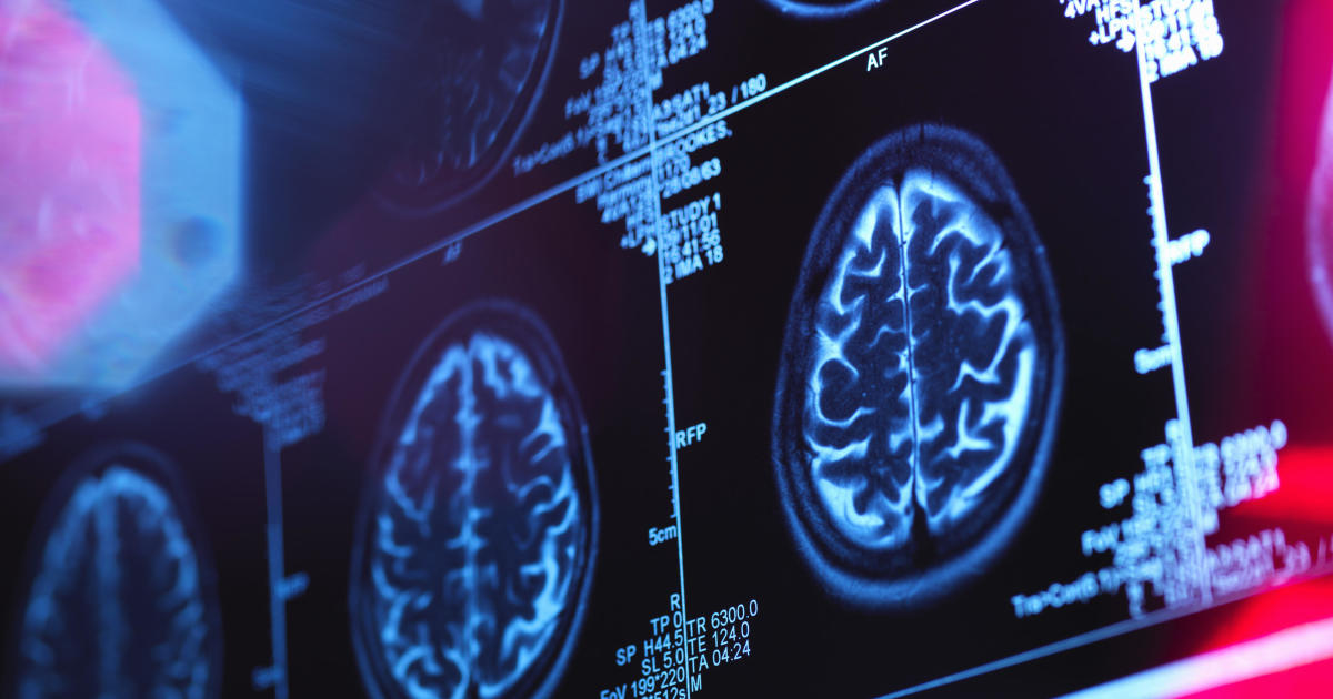 Otestujte své riziko demence a mrtvice pomocí skóre péče o mozek z Massachusetts General Hospital